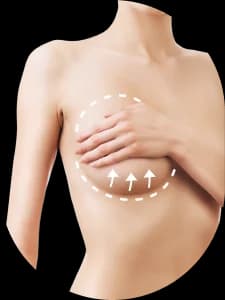 Augmentace prsou implantáty