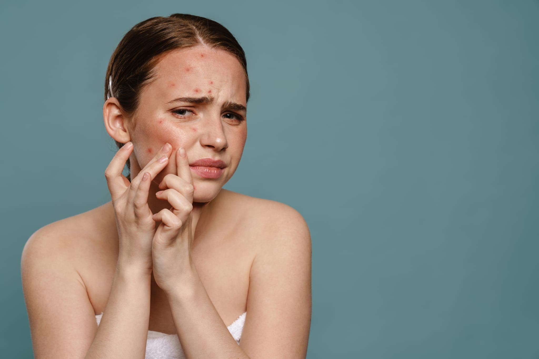 Akné v dospělosti: estetické a dermatologické řešení